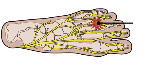 Illustration of nerves in the foot with indicators of where Morton’s Neuroma takes effect